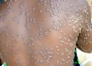 Sud-kivu: Le Mpox demeure une réalité. 1301 cas ont été notifié depuis Janvier 2026 et un décès (DPS)