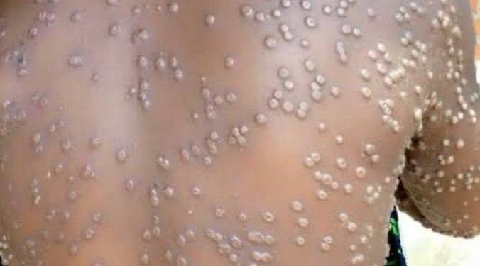 Sud-kivu: Le Mpox demeure une réalité. 1301 cas ont été notifié depuis Janvier 2026 et un décès (DPS)