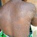 Sud-kivu: Le Mpox demeure une réalité. 1301 cas ont été notifié depuis Janvier 2026 et un décès (DPS)